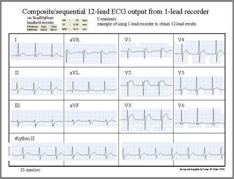 Download 12 Lead Ecg Template free software - thepiratebayscience