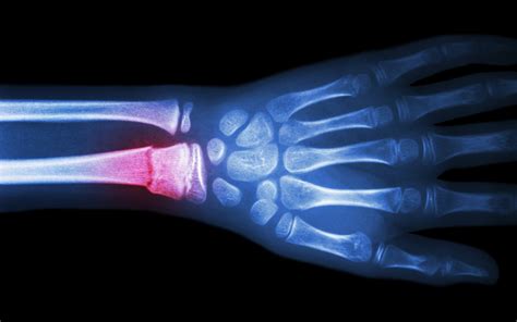 A promising new strategy to help broken bones heal faster | Penn Today