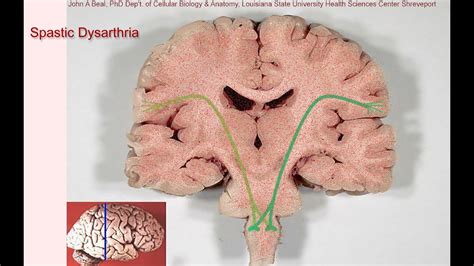 Spastic dysarthria - samples and tutorial - YouTube