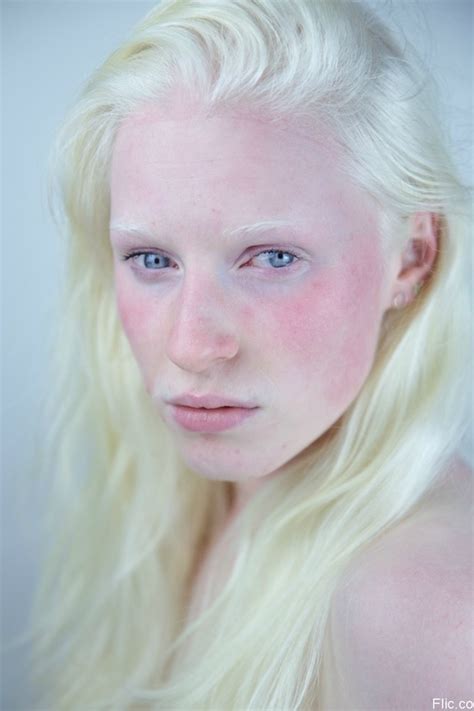 Types of Albinism - Albinism