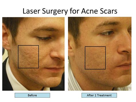 Types of Acne Scars, Treat Acne Scars with the Best Scar Treatments