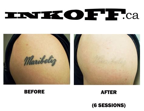 Black Tattoo Removal (Before/After 6 sessions)