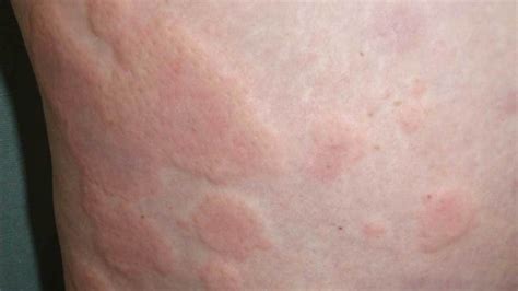 Treatment for Hives - Philadelphia Homeopathic Clinic - Dr. Tsan & Assoc.