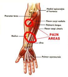 Forearm Tendonitis Injury: All you need to know | Playo