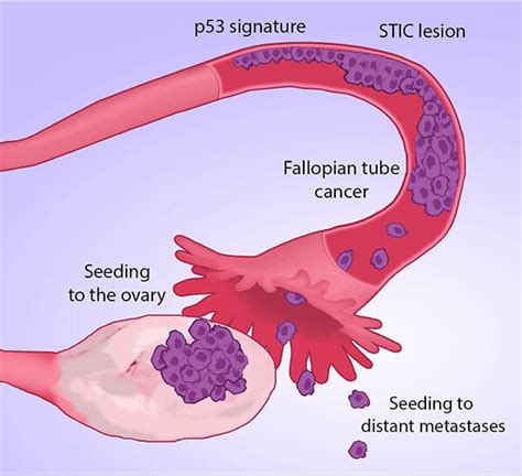 Many Ovarian Cancers May Start in Fallopian Tubes - NCI