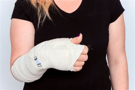 Young Female with Broken Hand in Cast Stock Image - Image of gypsum ...