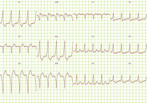 Wolff-Parkinson-White syndrome EKG examples - wikidoc