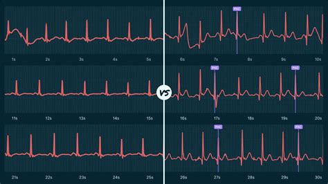 Sinus Arrhythmia Vs. Premature Atrial Contraction (Multiple) on Your ...