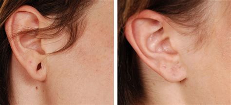 Ear Lobe Repair, Procedure and Cause and Treatment | Sab Clinic