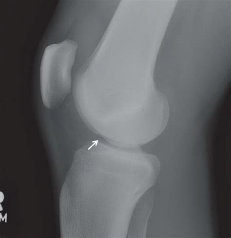 Radiographic Signs of ACL Tear | Radiology Key