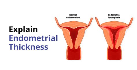 Endometrial Thickness: Causes ,Symptoms & Treatment | Birla Fertility & IVF