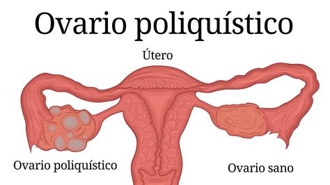 Síndrome ovario poliquístico y fertilidad: todo lo que hay que saber ...