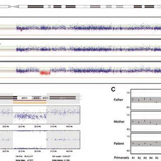 A: SNP array data from the patient and her parents showing a deletion ...