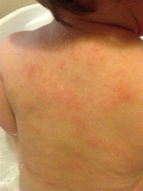 Food allergy? Eczema? - Netmums Chat