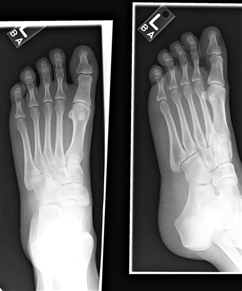 NORMAL FOOT 5 - Buyxraysonline