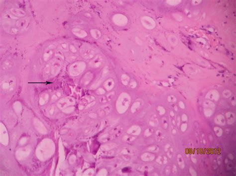 CHONDROSARCOMA – Histopathology.guru