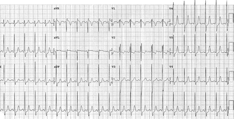 Pre-excitation syndromes • LITFL • ECG Library Diagnosis