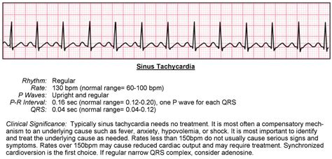 Paroxysmal Atrial Tachycardia Vs Sinus Tachycardia