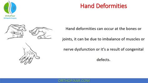 Hand Deformities | OrthoFixar 2024