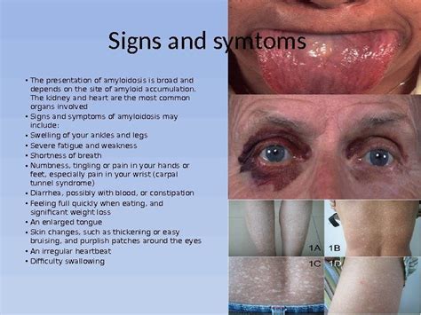 Amyloidosis symptoms and signs – Prnso