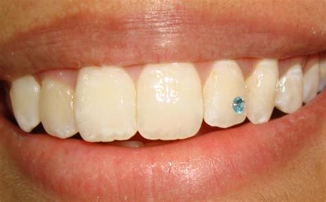 DIAMONDS ON TEETH AHMEDABAD, TOOTH JWELLERY, TOOTH CRYSTALS LAMINATES ...