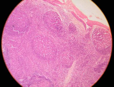 Tonsil Histology - Palatine tonsil - histology slide