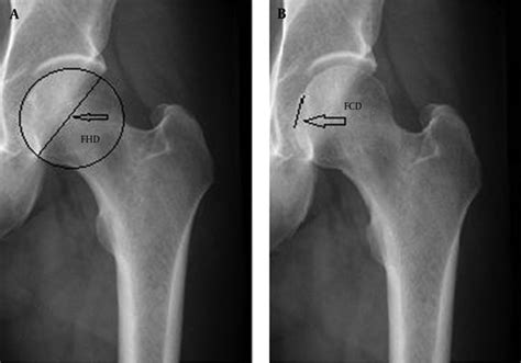 Femoral Head Fovea Capitis Variant Configurations and Age Related ...