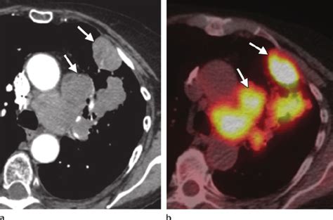 Small cell lung cancer. Chest CT scan (a) and corresponding PET/CT ...