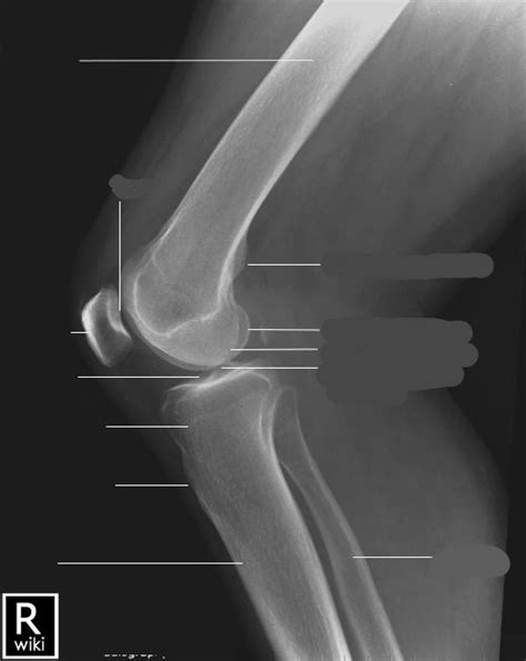 X-ray Anatomy - Lateral Knee Diagram | Quizlet