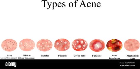 Types of Acne Skin inflammation. Pimples, boils, whitehead, closed ...