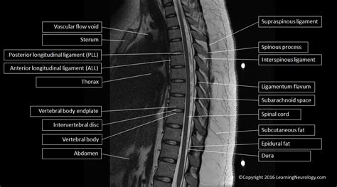 Approach to MRI Spine | LearningNeurology.com