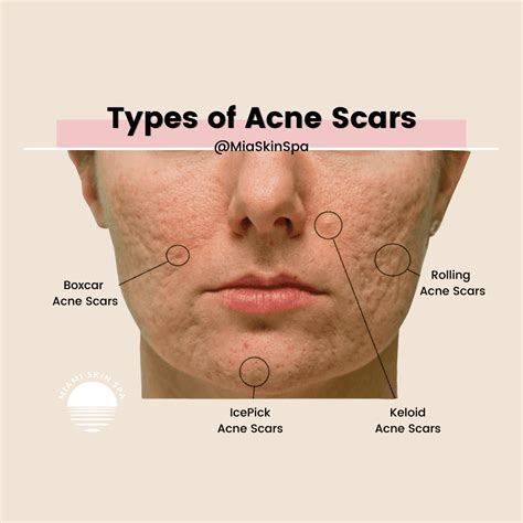 Face Scars From Acne