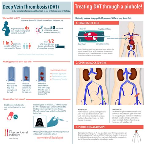 Treatment for Deep Vein Thrombosis in Denver, CO | MIPS Vein Center