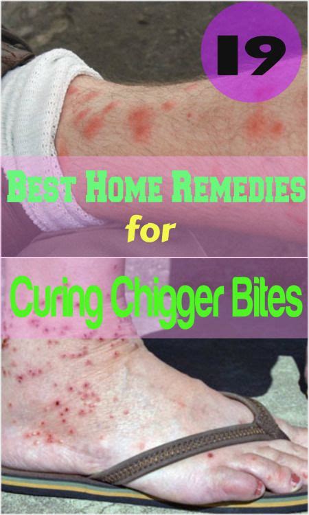 Bug Bites Remedies, Home Remedies, Natural Remedies, Sick Remedies, Diy ...