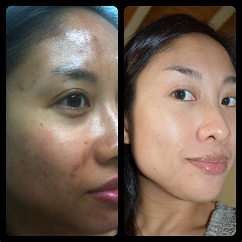 Obagi NuDerm for Acne and Hyperpigmentation – Pixiemama