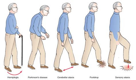 Neuro Exam: Post-Stroke Hemiplegic Gait – StrokeSciences