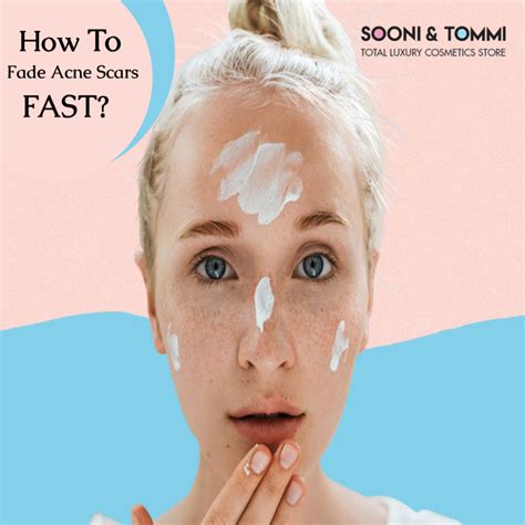 Solution To Get Rid Of Acne Scars | Sooni And Tommi