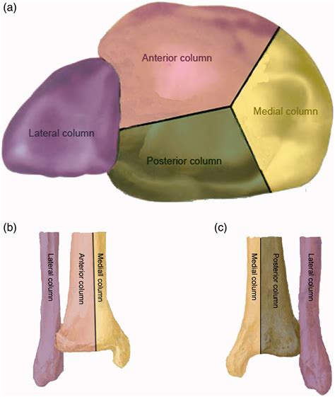 Schematic layout of four-column classification of tibial plafond. (a ...