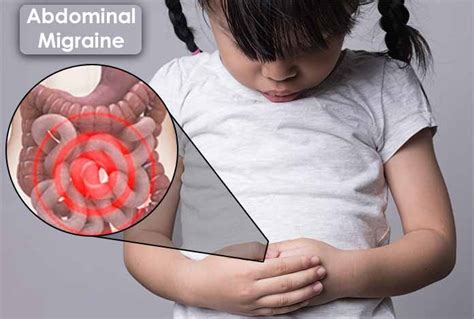 Understanding Abdominal Migraine: Causes, Symptoms, and Treatment ...