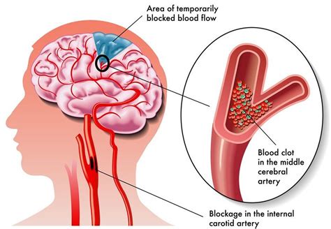 Mini Stroke - TIA Stroke, Causes, Symptoms, Signs, Treatment