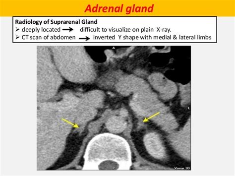 Adrenal Gland Anatomy Ct