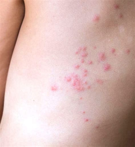 Bed Bug Bites Pictures, Symptoms: What Do Bed Bug Bites Look Like ...