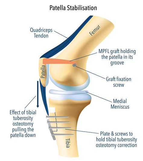 How Much Does Kneecap Surgery Cost?