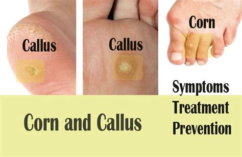 15 Natural Home Remedies to Get Rid of Calluses and Corns on Feet ...