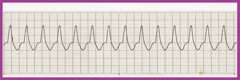 EKG Rhythm Strip Quiz 190