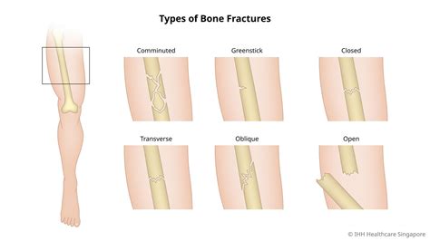 Bone Fractures - Symptoms & Causes | Parkway Shenton