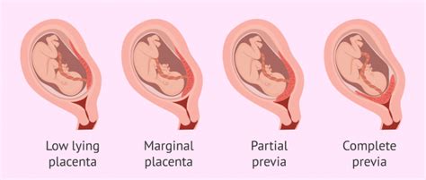 Types of placenta previa