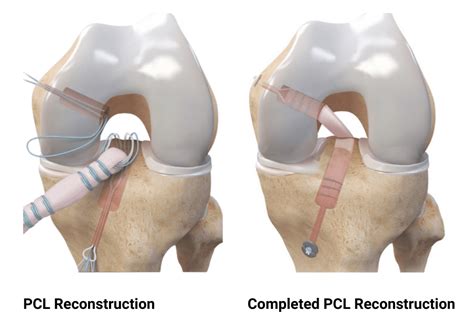 Posterior Cruciate Ligament (PCL) Tears | Dr. Edward S. Chang, MD