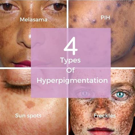 There are 4 main types of hyperpigmentation. PIH -post inflammatory ...