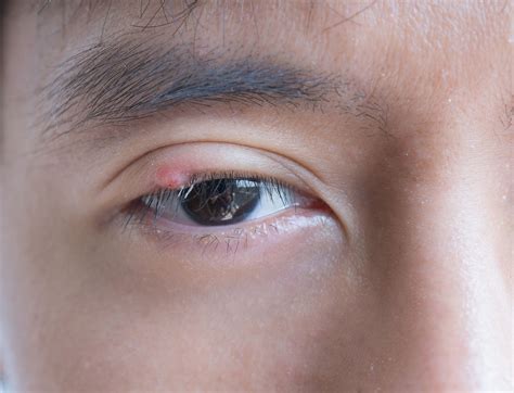 Chalazion vs. Stye: Symptoms, Causes, and Treatment